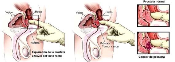 tacto rectal próstata