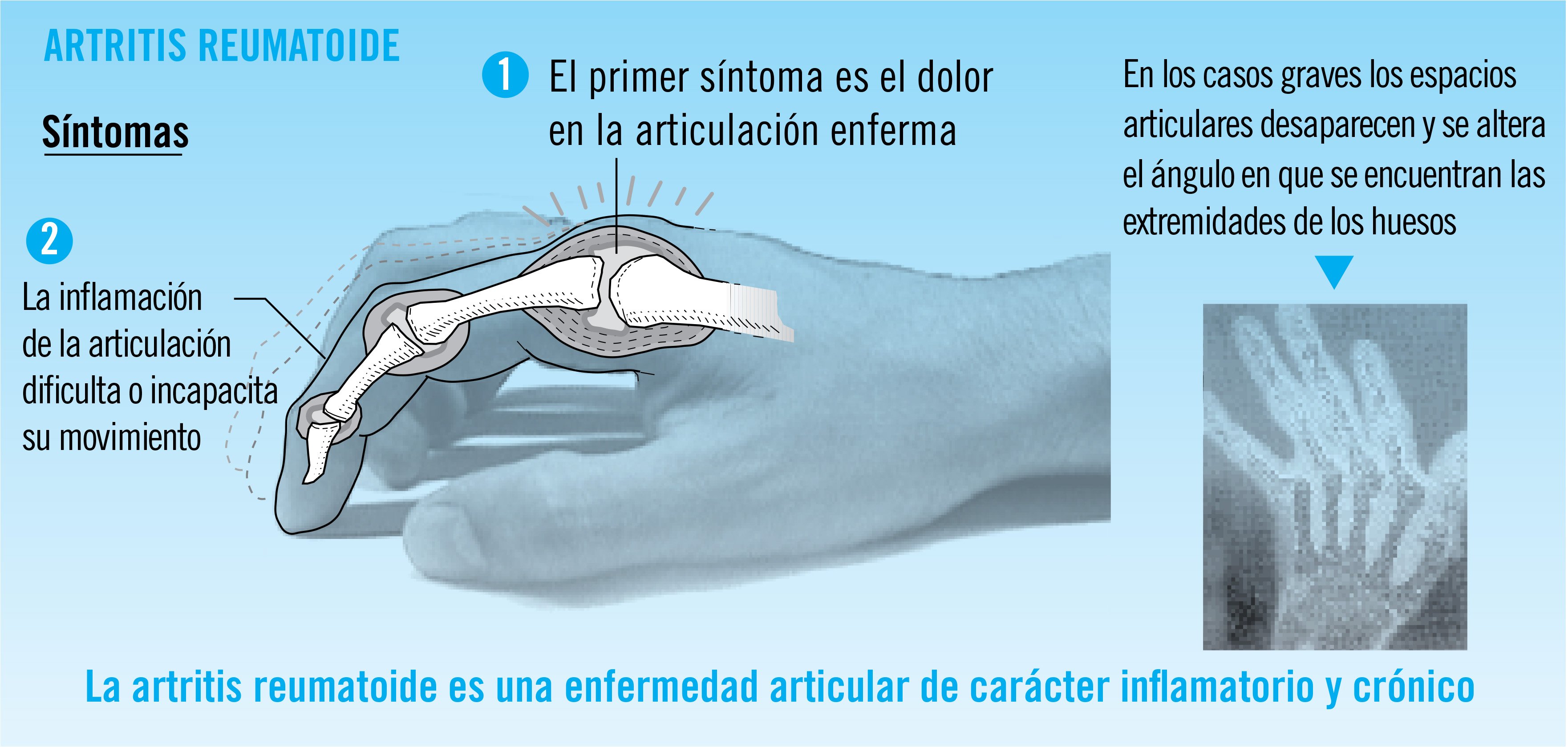 Artritis reumatoide qué es y cuáles son sus síntomas