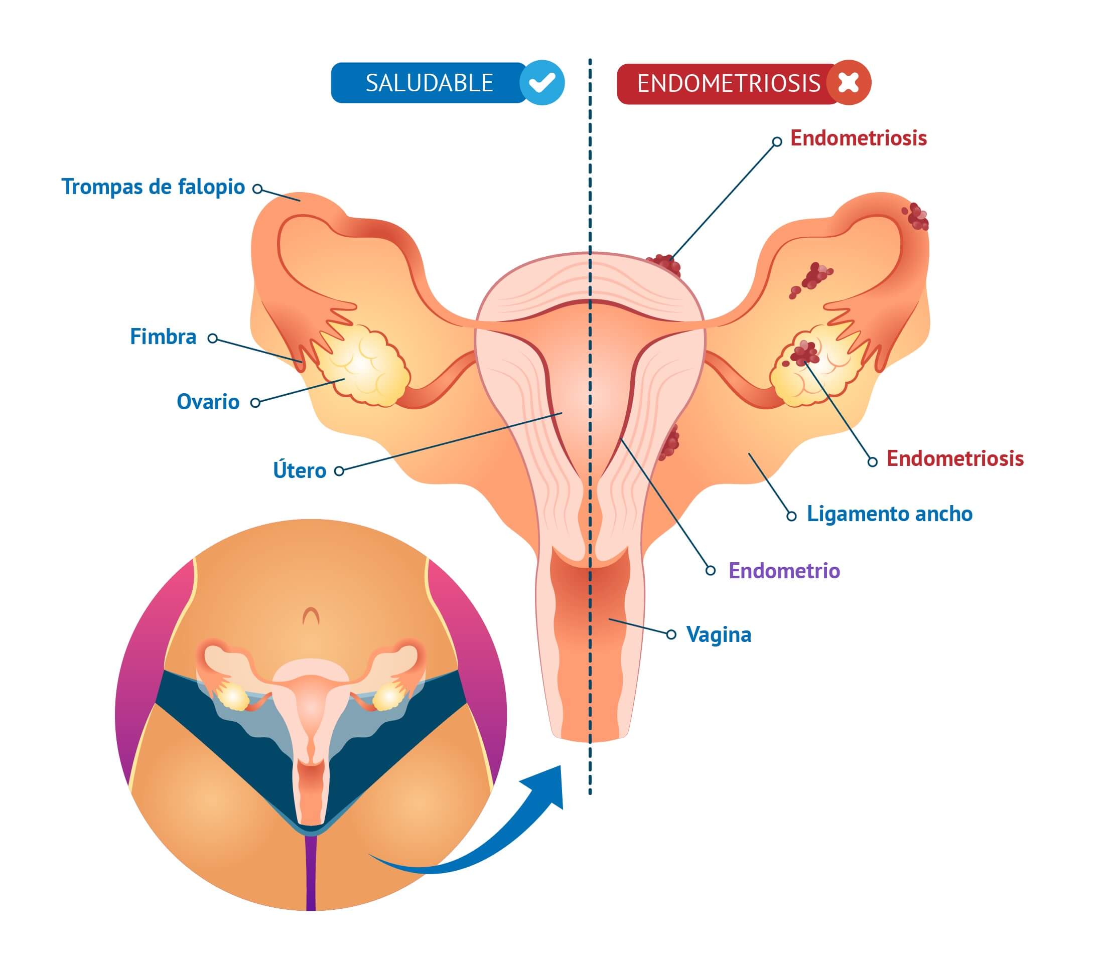 endometriosis-sintomas-tratamiento-diagnostico