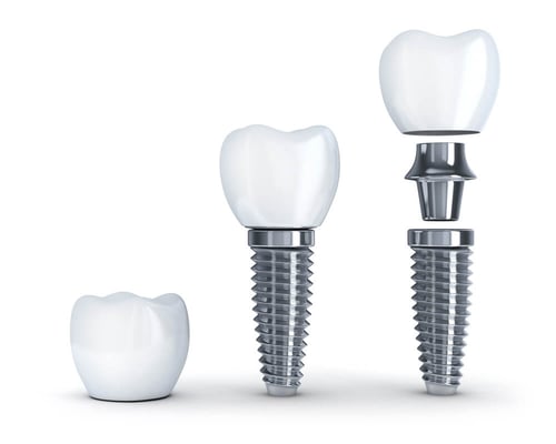 implante-dental-tornillo