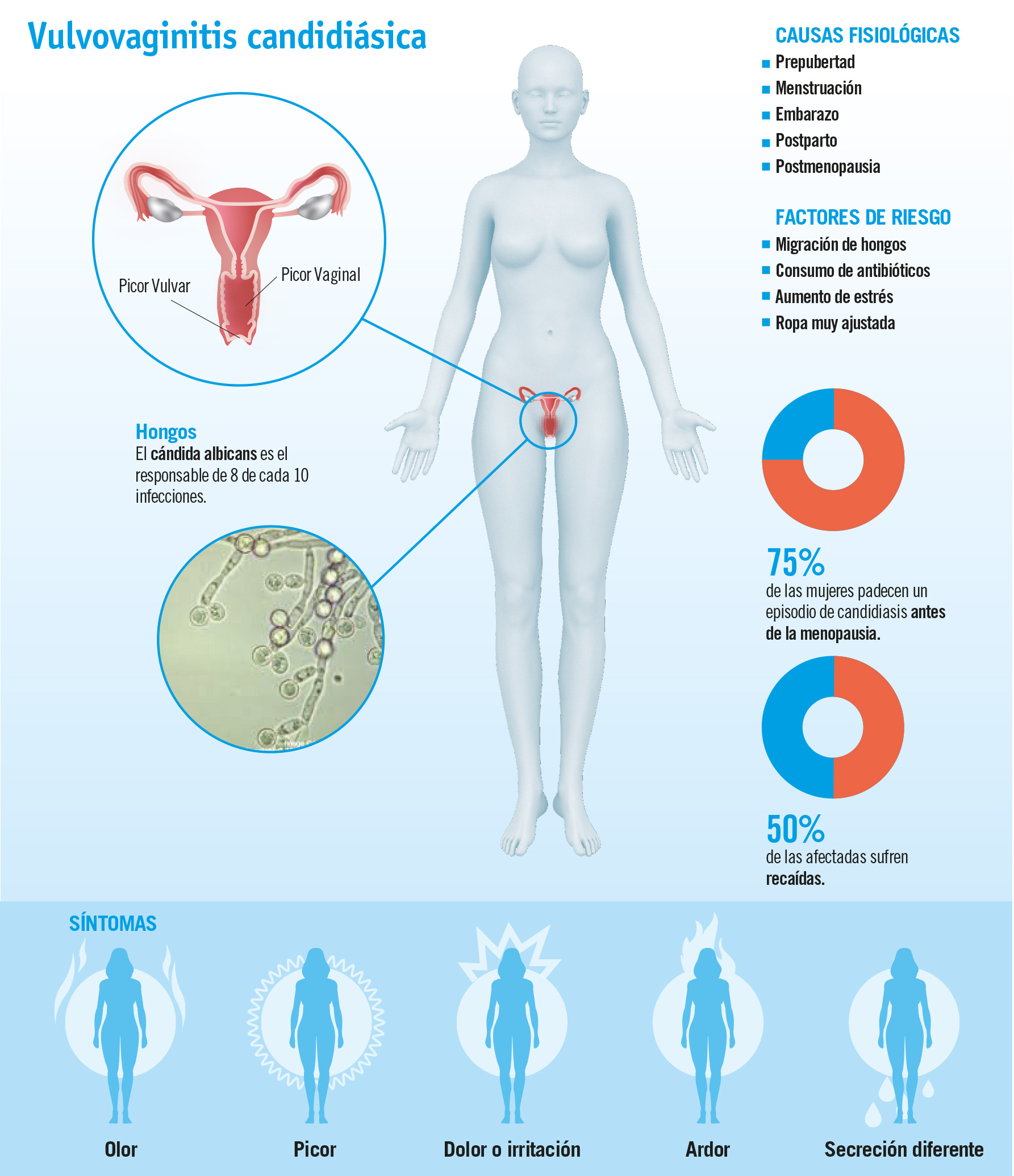 Candidiasis: una infección vaginal cada vez más frecuente