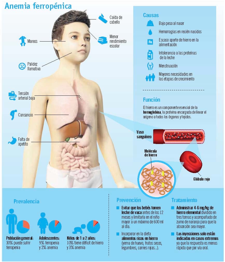 Ferropenia, principal causa de anemia en niños