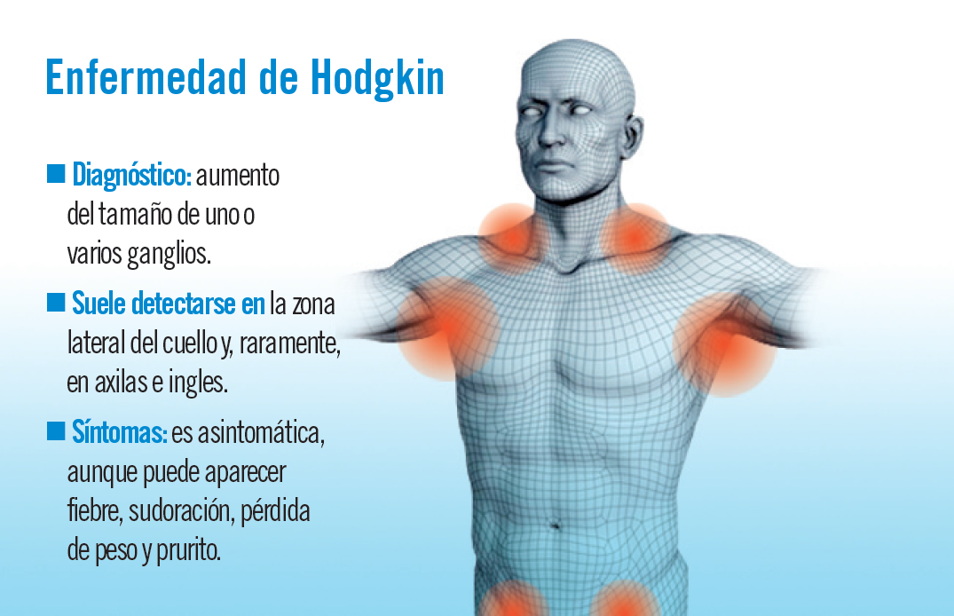 Cancer ganglios hodgkin, Cancer hodgkin causas, 2. Hipotiroidism
