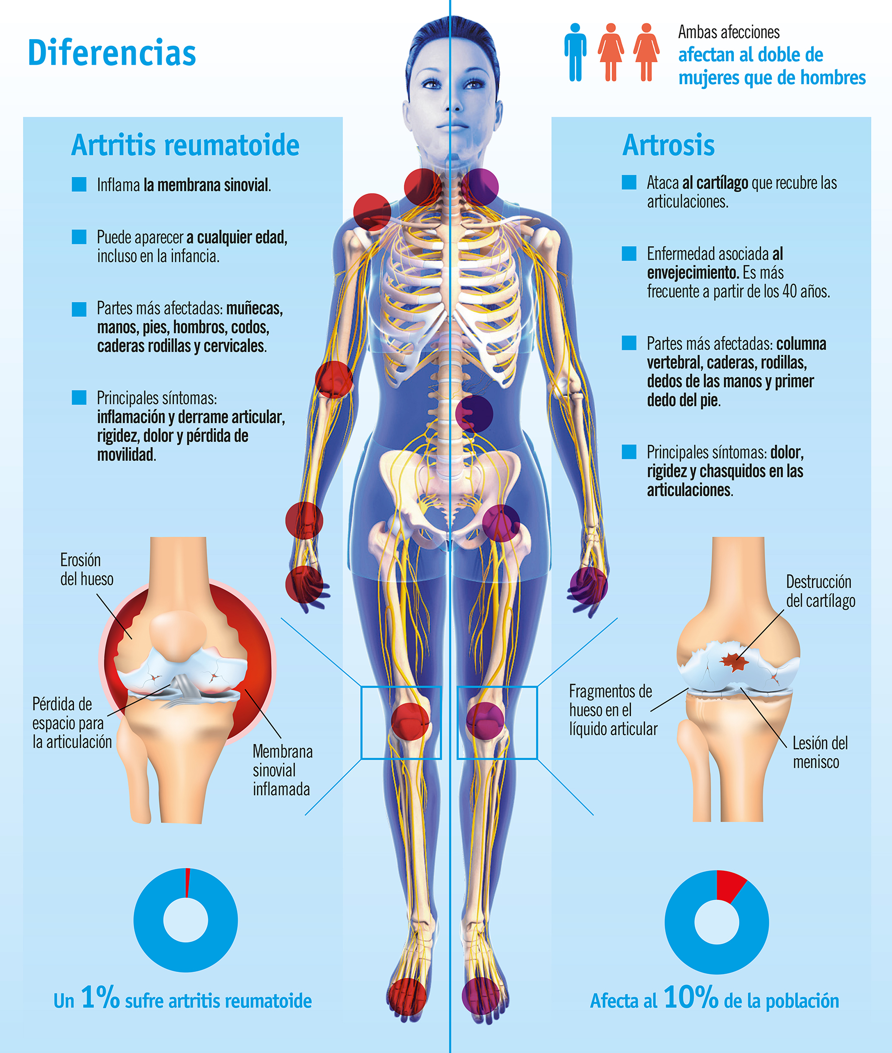 Artrosis y artritis, dolor en las articulaciones