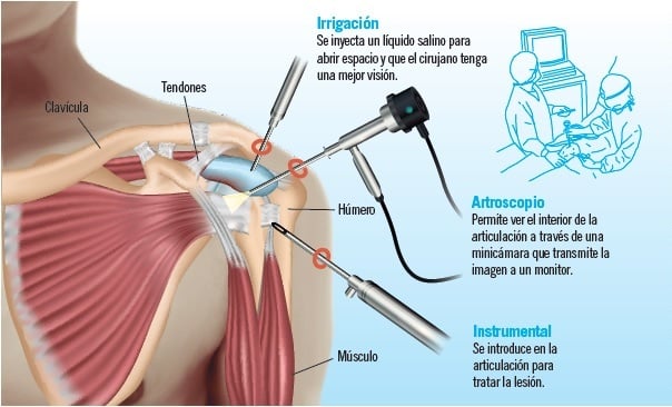 Ilustrar Mula engranaje Cirugía artroscópica: ideal para las lesiones articulares