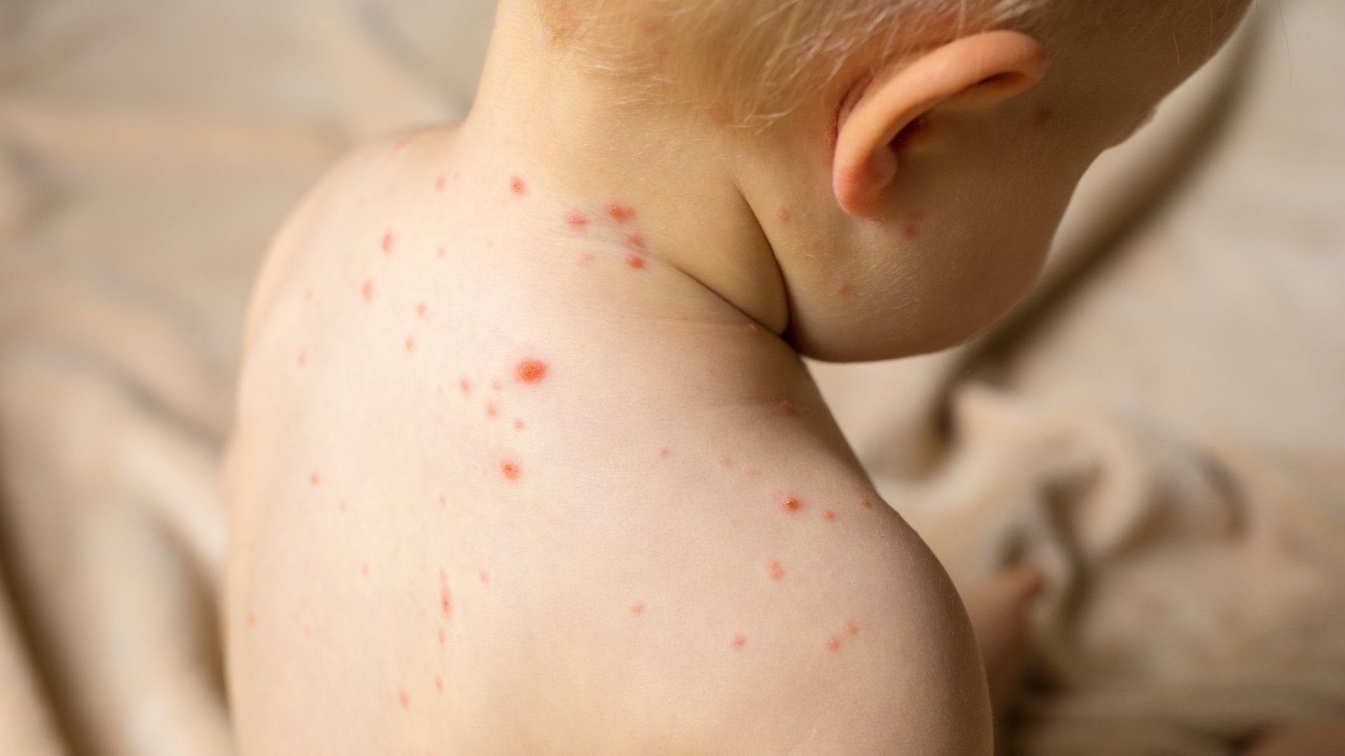 ¿Cuáles son las diferencias entre la varicela y el sarampión?