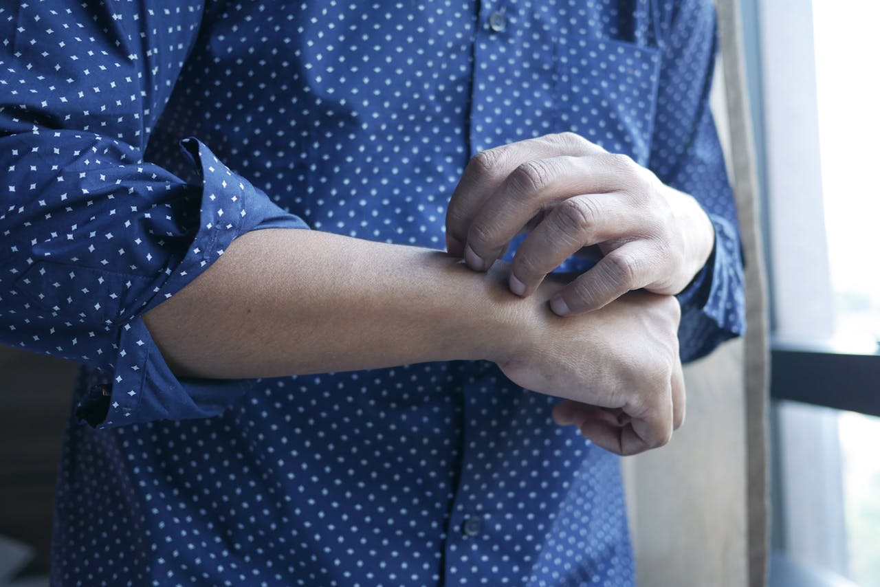 hombre rasca el brazo con eccema o psoriasis