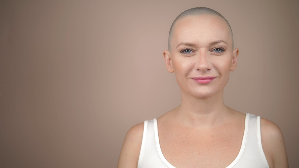 Alopecia femenina: Tipos y tratamientos